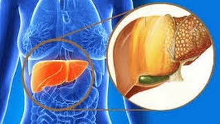 ➦ Gordura no fígado esteatose hepática [upl. by Rettuc]