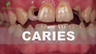 ¡Revierte Y Cura Las Caries Dentales Con ESTOS 5 Pasos… ¡Impresionante Despídete De Ir Al Dentist [upl. by Landahl]