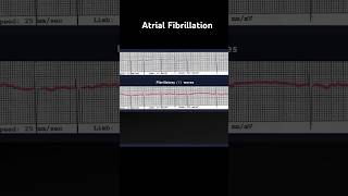 Atrial Fibrillation ECG Fibrillatory f Waves [upl. by Ailel52]