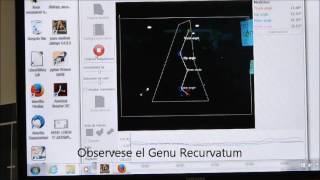 ANALISIS DEL MOVIMIENTO Genu Recurvatum [upl. by Noicnecsa]