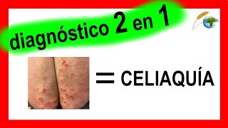 Dermatitis Herpetiforme DIAGNOSTICO amp DIAGNOSTICO DIFERENCIAL  fotos Inmunofluorescencia directa [upl. by Artinek]