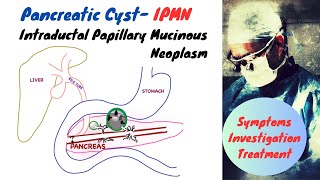 Pancreatic Cyst IPMN [upl. by Vassar]