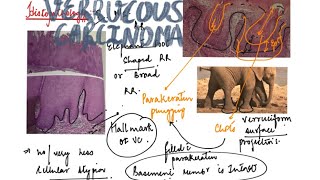 Verrucous carcinoma [upl. by Roose]