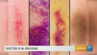 Why bruising matters and what the purple blue and yellow marks can indicate [upl. by Vallery]