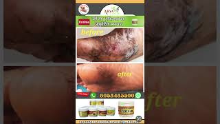 Eczema ayurvedic skin care eczema skincare eczematips eczematreatment ayurveda skincareroutine [upl. by Bast]