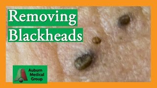 Several Blackheads  Auburn Medical Group [upl. by Chuch367]