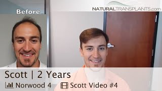 Transplant Hair Video ￼ 2 Year Transplant Hair Growth Timeline Scott [upl. by Lawley]