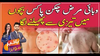 Chickenpox in Children  Symptoms Diagnosis and Treatment  Watch video [upl. by Leahcimrej]