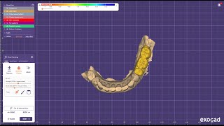 Lower premolar amp molar designing for basal implant in Exocad elefsina 32 [upl. by Debera]