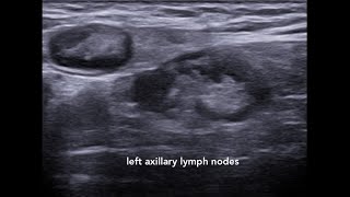 Axillary Lymphadenopathy Ultrasound Case 1 [upl. by Alvy]