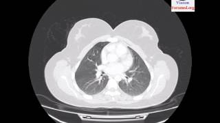 IRM du Parenchyme Pulmonaire Aspect Normal [upl. by Peri]