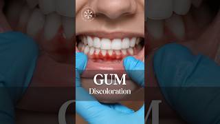 Transform Your Smile with Gum Depigmentation Dental Health enfieldroyalclinic gumdisease [upl. by Asetal117]