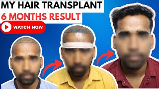 Hair Transplant of 2500 Grafts  Hair Transplant Timeline Of 6 Months ResultsHairMateClinic [upl. by Schaffel863]