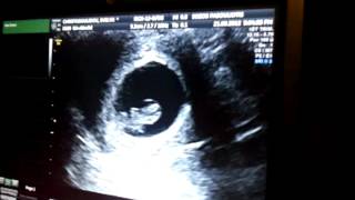 BABY HEARTBEAT  8 WEEKS 3 DAYS PREGNANT [upl. by Proulx301]