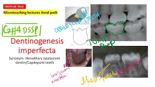 Dentinogenesis Imperfecta  Type 1 and 2 High yield points with diagramsNEET MDS  INICET  INBDE [upl. by Etteluap]