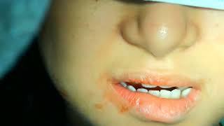 dentigerous cyst removal in mandible for a 13yr old girl  by drcmurugavel [upl. by Llewkcor]