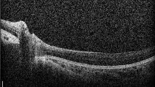 Retinosis  distrofias de la retina tipo RPGR [upl. by Misab]