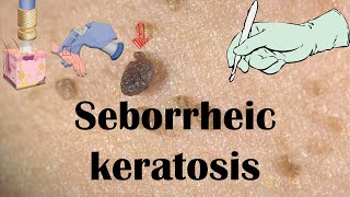 Seborrheic Keratosis Dermatitis Age Spots  Causes Signs amp Symptoms amp Treatment [upl. by Ariaet631]