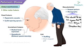 Parkinsons Disease🧠  Etiology  Pathophysiology  Clinical manifestations  Diagnosis  Treatment [upl. by Pattin5]