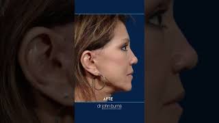 Facelift Before amp After  10 year Facelift Results [upl. by Anigger991]