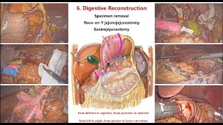 Laparoscopic Distal Gastrectomy With D2 Lymphadenectomy amp Intracorporal RouxenY Gastrojejunostomy [upl. by Trici]