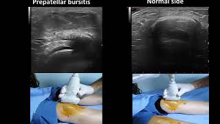 Ultrasound guided prepatellar bursitis injection Housemaids knee [upl. by Urbai319]