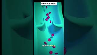 Varicose Veins heart cvs artery vein thrombus [upl. by Ettennan]