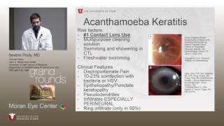 A Case of Acanthameoba Keratitis [upl. by Legnaleugim]