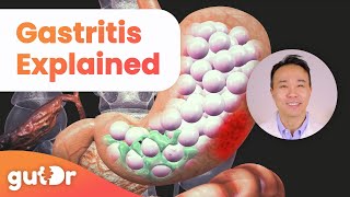 What is Gastritis  The GutDr Explains 3D Gut Animation [upl. by Eelhsa]