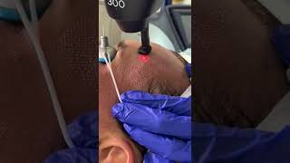 Laser resurfacing with CO2 laser Lutronic [upl. by Layne615]