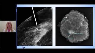 How Lincoln Surgical Hospital uses 3D Tomosynthesis to assess Breast Specimen Margins [upl. by Nanda]