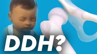 Developmental Dysplasia of the Hip [upl. by Leahci]