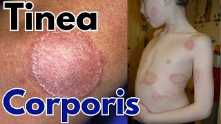 Tinea corporis infection  Ring worm symptoms treatment and causes [upl. by Frolick]