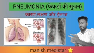 Pneumonia न्योमोनिया के कारणलक्षण और उपचार [upl. by Ahsinauj]