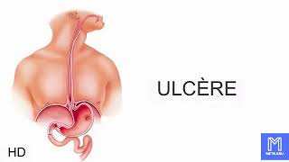 Ulcère causes signes et symptômes diagnostic et traitement [upl. by Ratha]