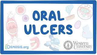 Western University  Oral Ulcers [upl. by Ennazor]