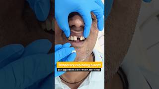 Temporary Cap over Front Dental Implant Try Maryland Bridge Dr Srishti Bhatia teeth dental [upl. by Tildy74]