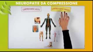 Neuropatie da Compressione [upl. by Eittak]