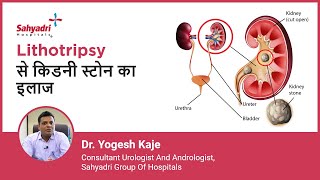 Lithotripsy से किडनी स्टोन का इलाज  Lithotripsy for Kidney Stones  Dr Yogesh Kaje Sahyadri [upl. by Mchugh471]