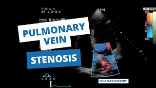 Pulmonary Vein Stenosis on Echocardiography [upl. by Modestine]