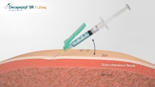 Decapeptyl  Communication pharmaceutique [upl. by Htenywg430]