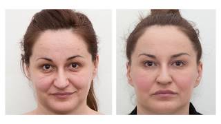 The results of dermal fillers before and after [upl. by Nirtak]