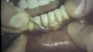 Scaling and Root Planing Part II Mandibular Teeth [upl. by Sillsby]