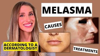 Best Melasma Treatment Dermatologist Explains Melasma Causes At Home Treatments amp More [upl. by Mudenihc116]