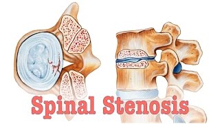 Spinal Stenosis  Surgery vs Chiropractic Care [upl. by Estrella]