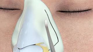 Ultrasonic Rhinoplasty [upl. by Anya482]