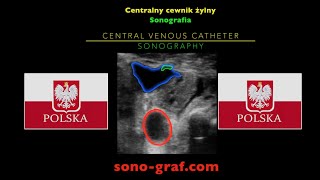 Sonografia USG — cewnik acdo żyły centralnej [upl. by Adnomal]