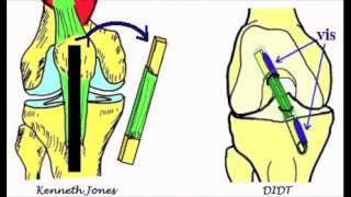 Bases anatomiques du ligament croisé antérieur [upl. by Pen]