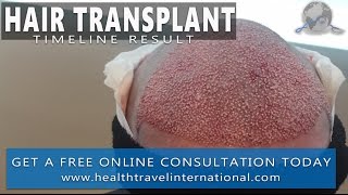 FUE Hair Transplant – 12 Month Timeline Result  Hair loss treatment  Receding hairline Men 2017 [upl. by Naujat]