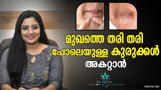 നെറ്റിയിലെയും മുഖത്തെയും തരി പോലെയുള്ള കുരുക്കൾ മാറാൻ HOW TO GET RID OF TINY BUMPS ON FOREHEAD FAST [upl. by Wing541]